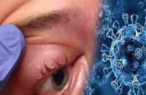 Young man dies of mucormycosis