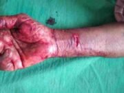 Bibatya attack a woman in Sangamner taluka, woman injured